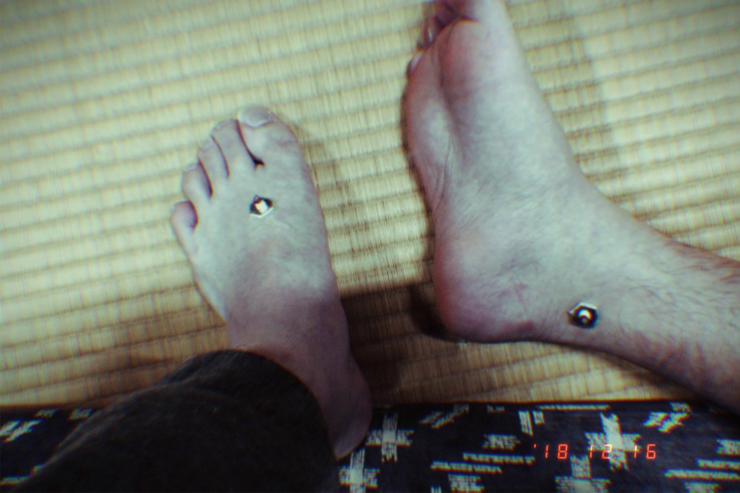 お灸をすえる 写真